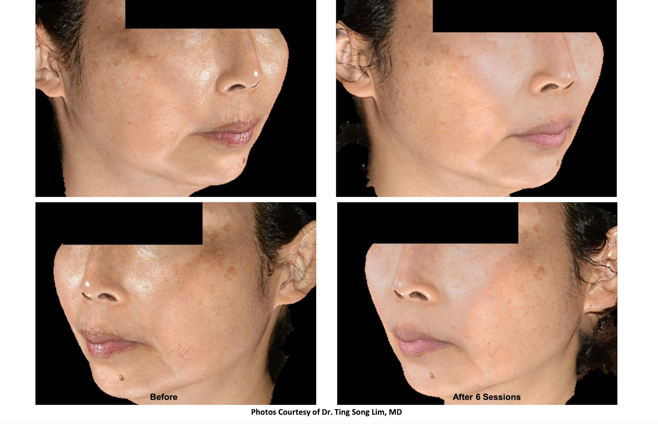 RF Microneedling Before & After Gallery - Patient 202647 - Image 1