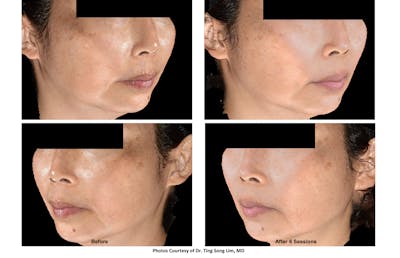 RF Microneedling Before & After Gallery - Patient 202647 - Image 1