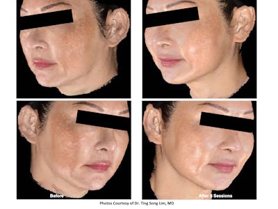RF Microneedling Before & After Gallery - Patient 346606 - Image 1