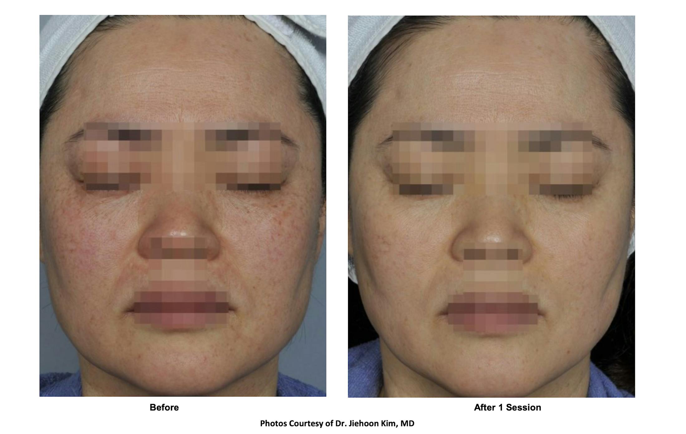 RF Microneedling Before & After Gallery - Patient 235049 - Image 1