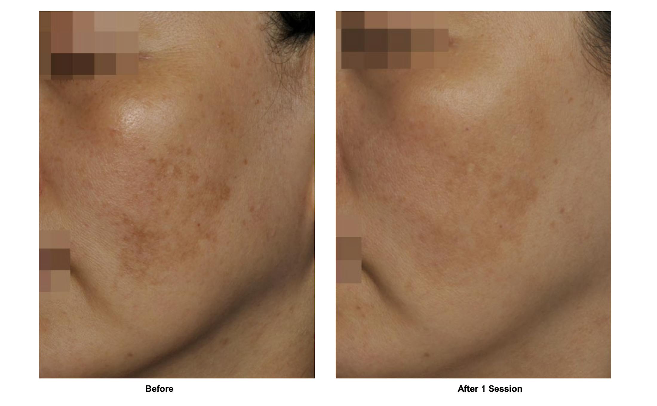 RF Microneedling Before & After Gallery - Patient 142379 - Image 1