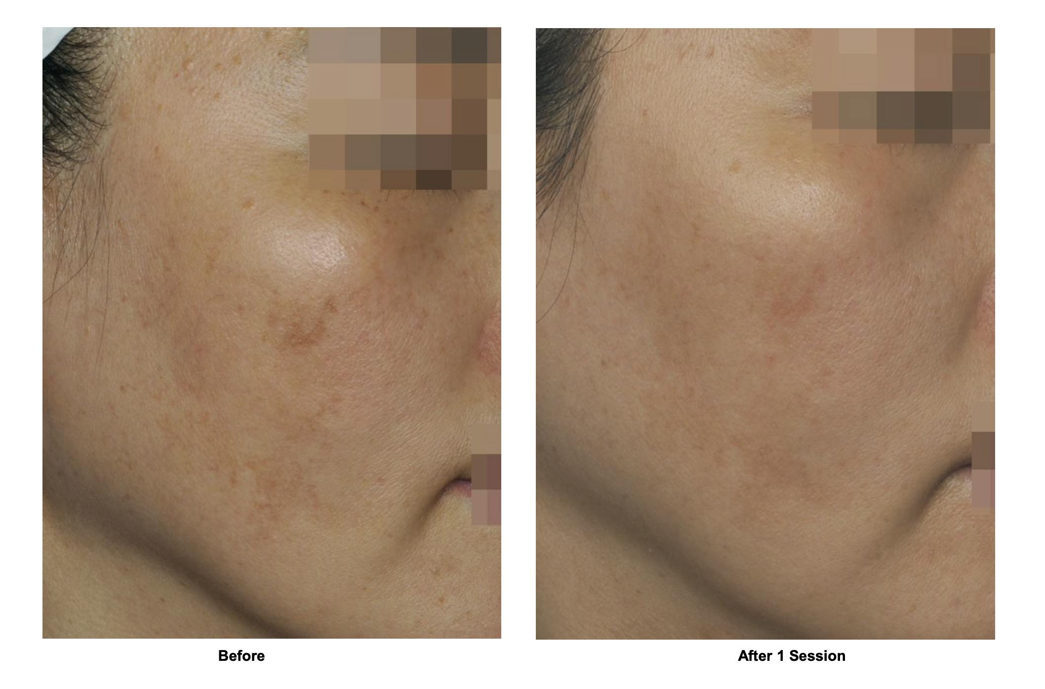 RF Microneedling Before & After Gallery - Patient 108080 - Image 1