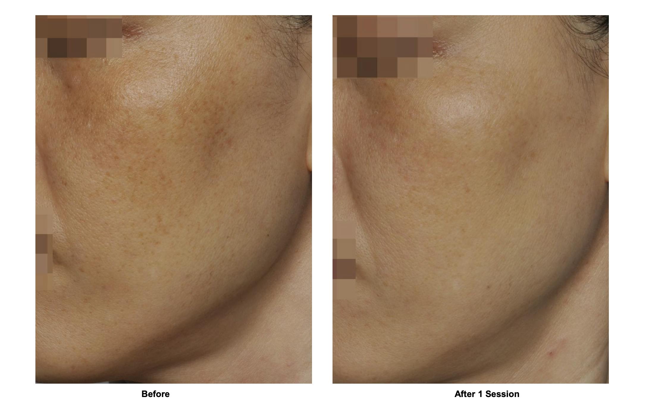 RF Microneedling Before & After Gallery - Patient 146558 - Image 1