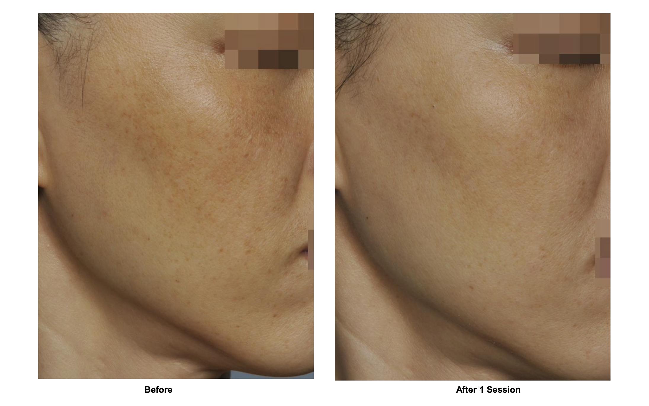RF Microneedling Before & After Gallery - Patient 284335 - Image 1