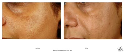 RF Microneedling Before & After Gallery - Patient 401694 - Image 1