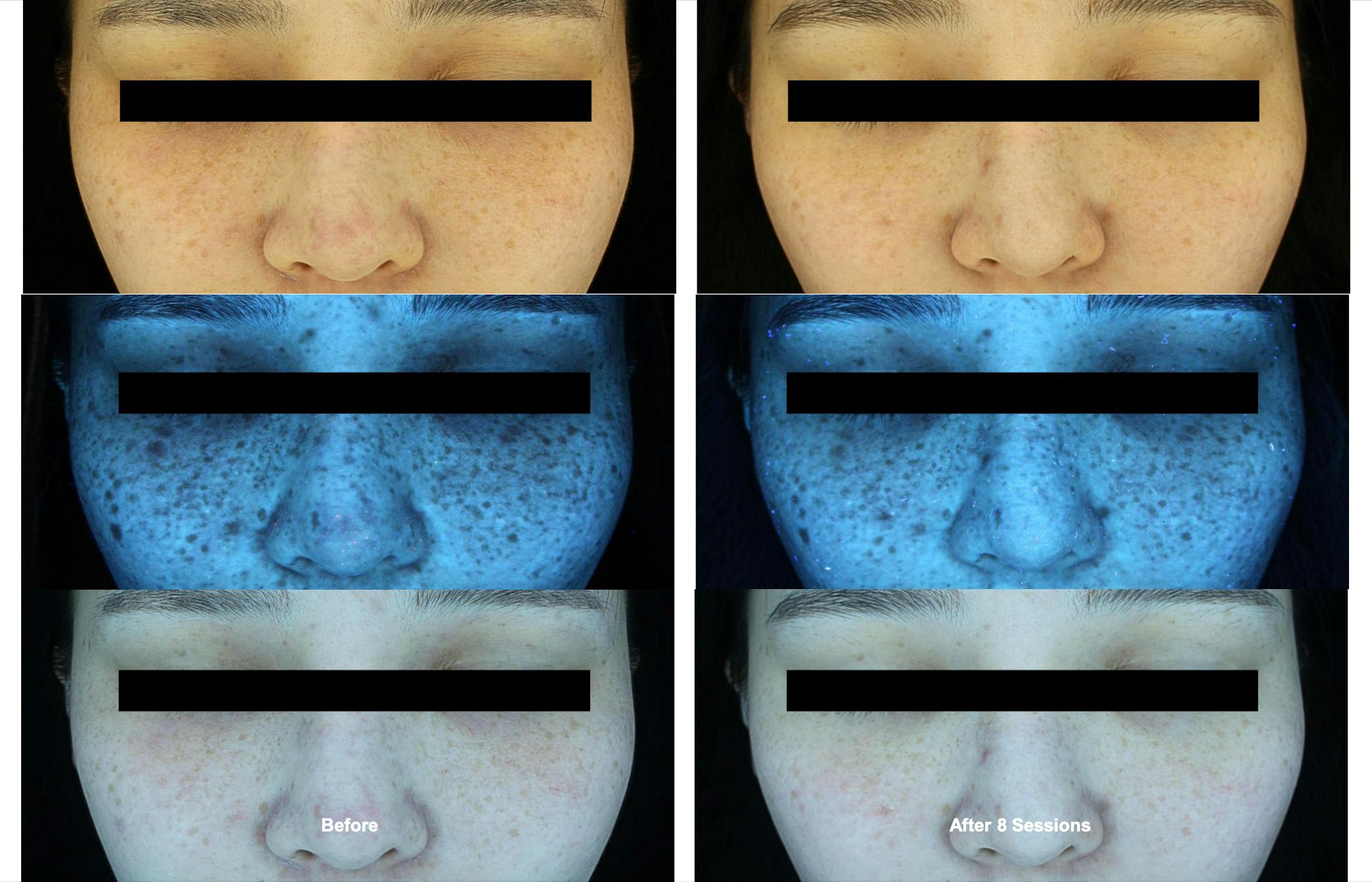 RF Microneedling Before & After Gallery - Patient 170585 - Image 1