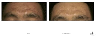 RF Microneedling Before & After Gallery - Patient 256261 - Image 1