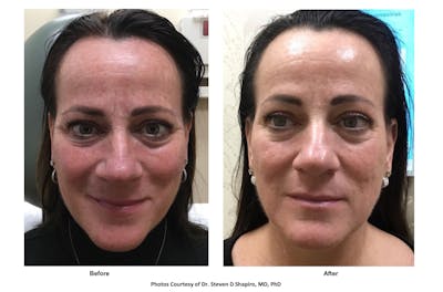 RF Microneedling Before & After Gallery - Patient 211001 - Image 1