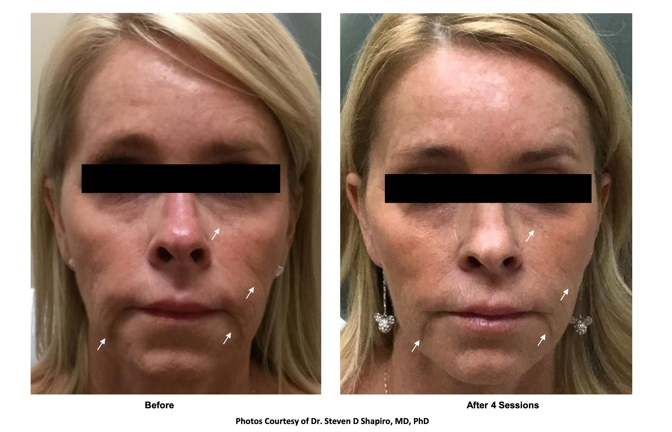 RF Microneedling Before & After Gallery - Patient 152610 - Image 1