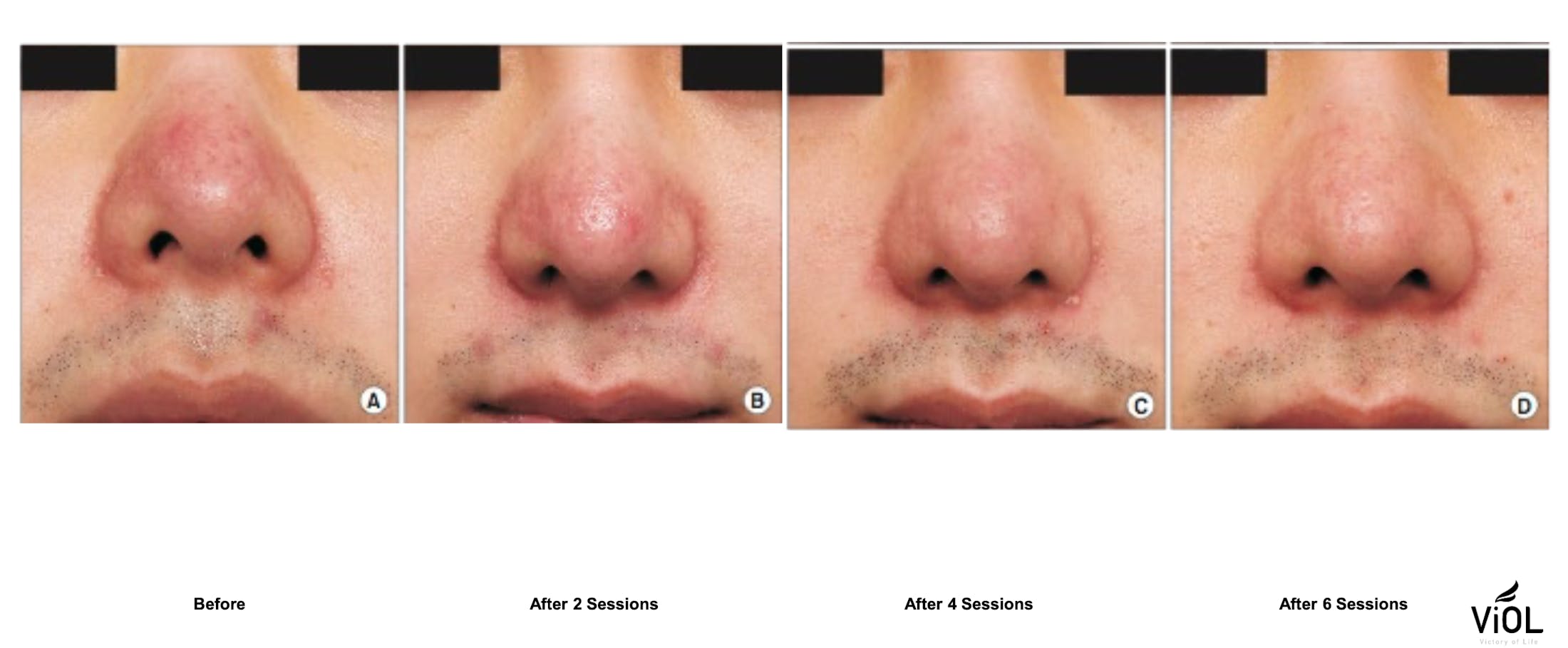 RF Microneedling Before & After Gallery - Patient 118021 - Image 1