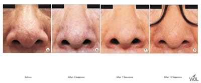 RF Microneedling Before & After Gallery - Patient 364496 - Image 1