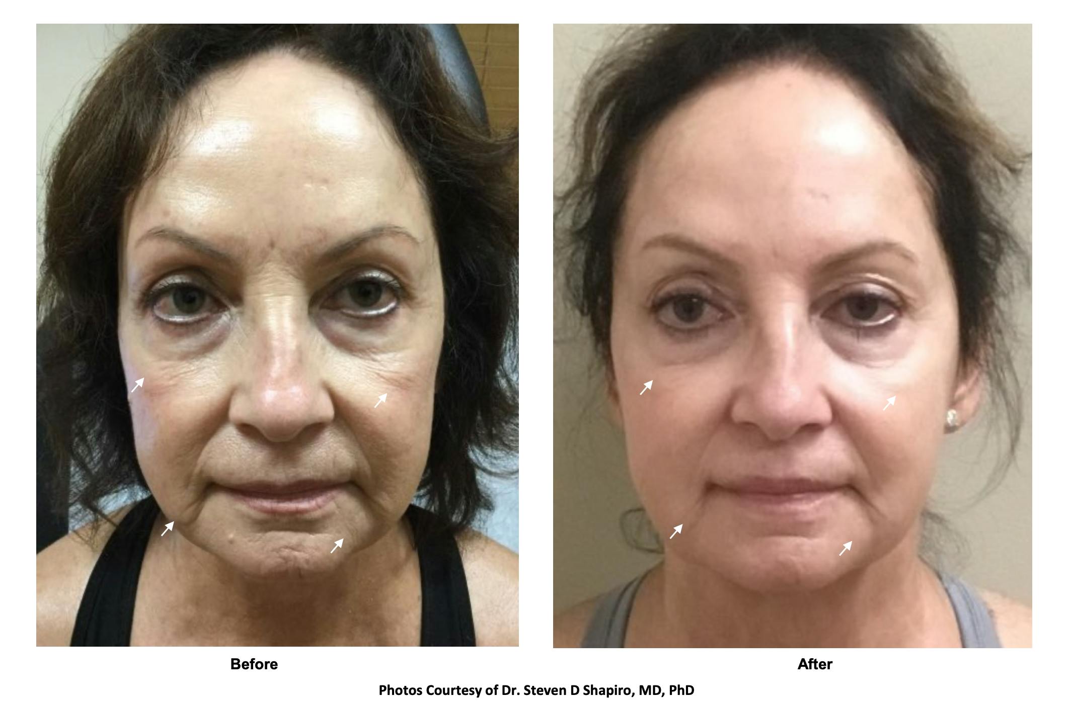 RF Microneedling Before & After Gallery - Patient 635604 - Image 1