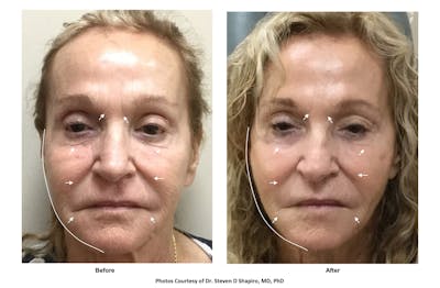 RF Microneedling Before & After Gallery - Patient 277401 - Image 1