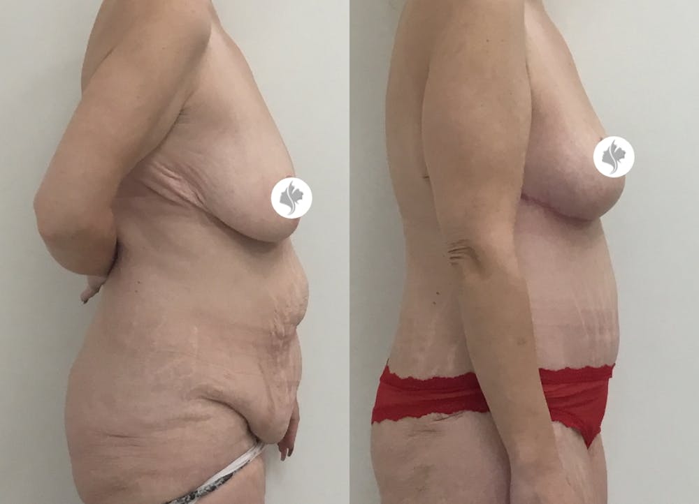 This is one of our beautiful post-bariatric body contouring patient #6