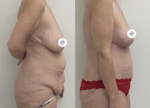 This is one of our beautiful post-bariatric body contouring patient 6