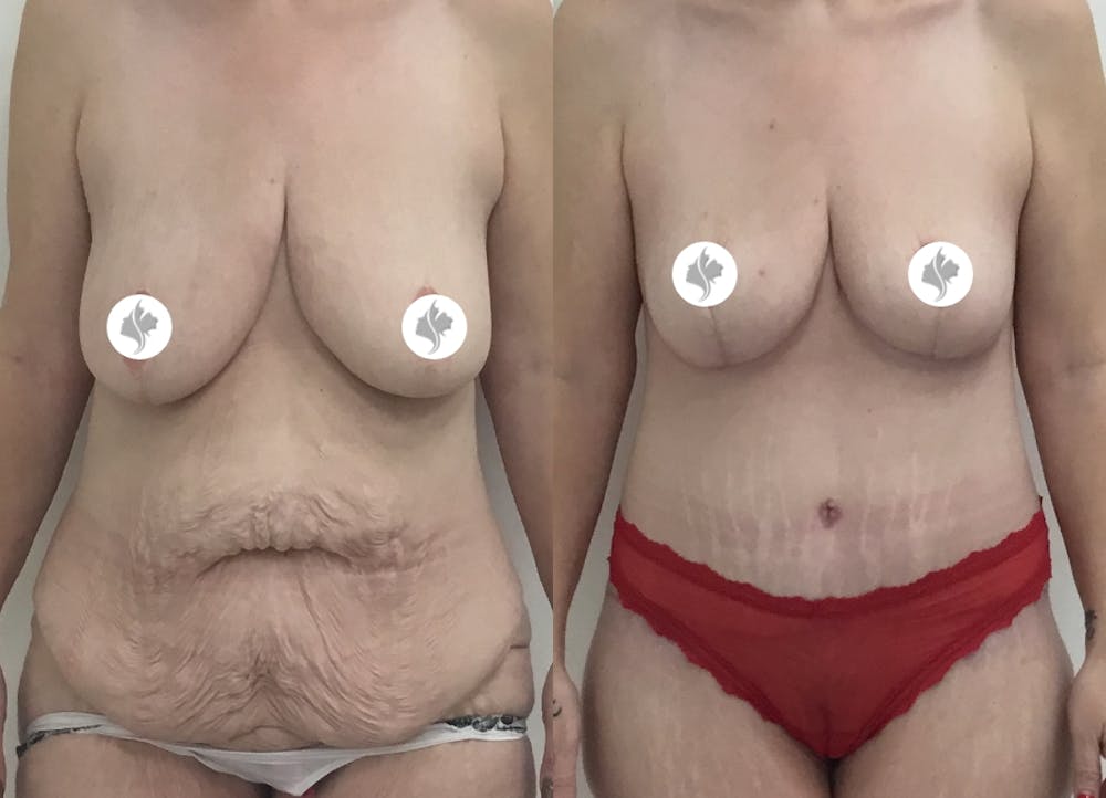 This is one of our beautiful post-bariatric body contouring patient #6