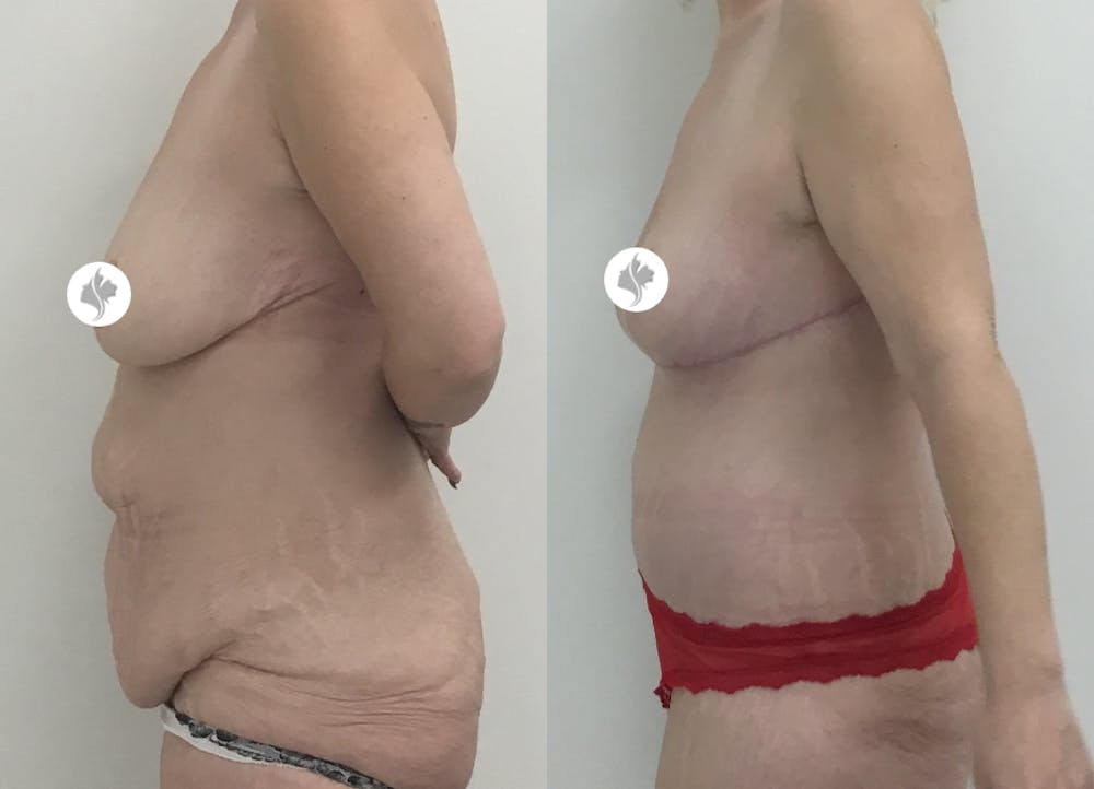 This is one of our beautiful post-bariatric body contouring patient #6