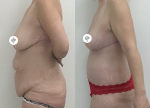 This is one of our beautiful post-bariatric body contouring patient 6