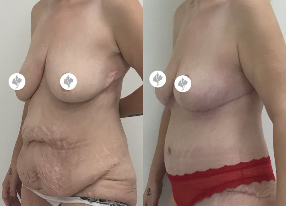 This is one of our beautiful post-bariatric body contouring patient #6