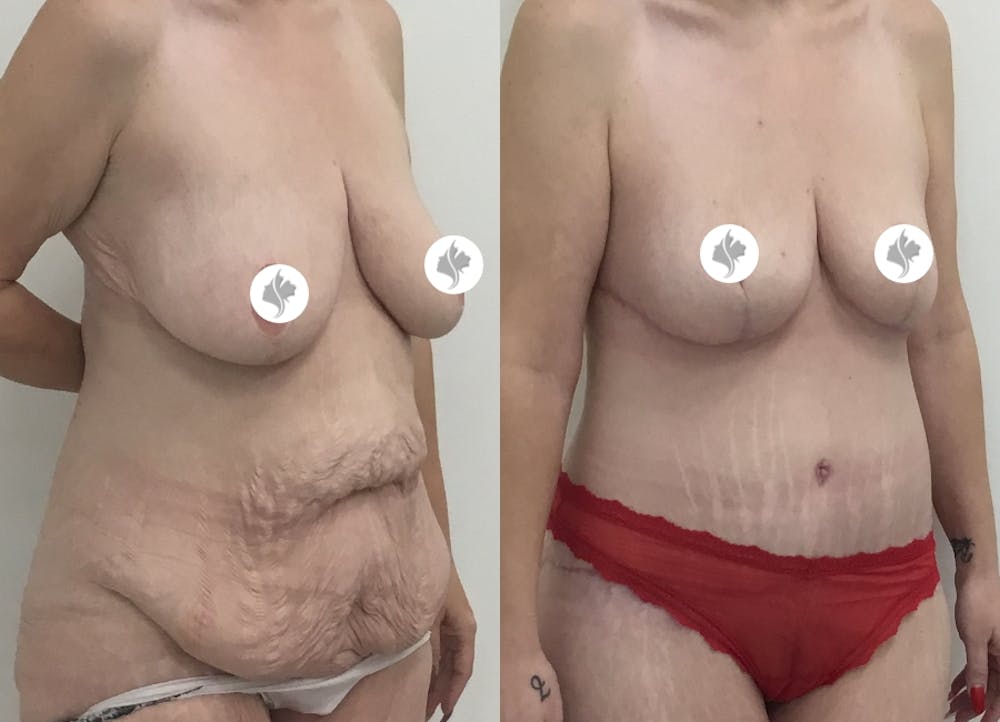 This is one of our beautiful post-bariatric body contouring patient #6