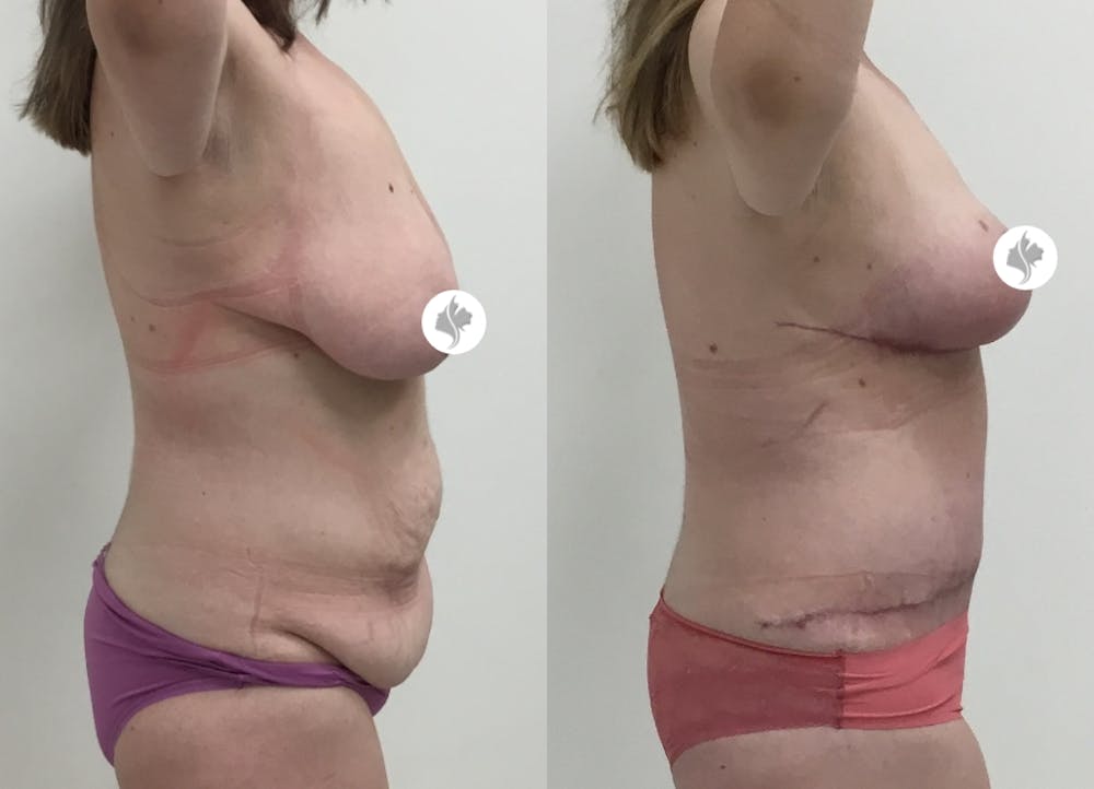 This is one of our beautiful tummy tuck patient #17