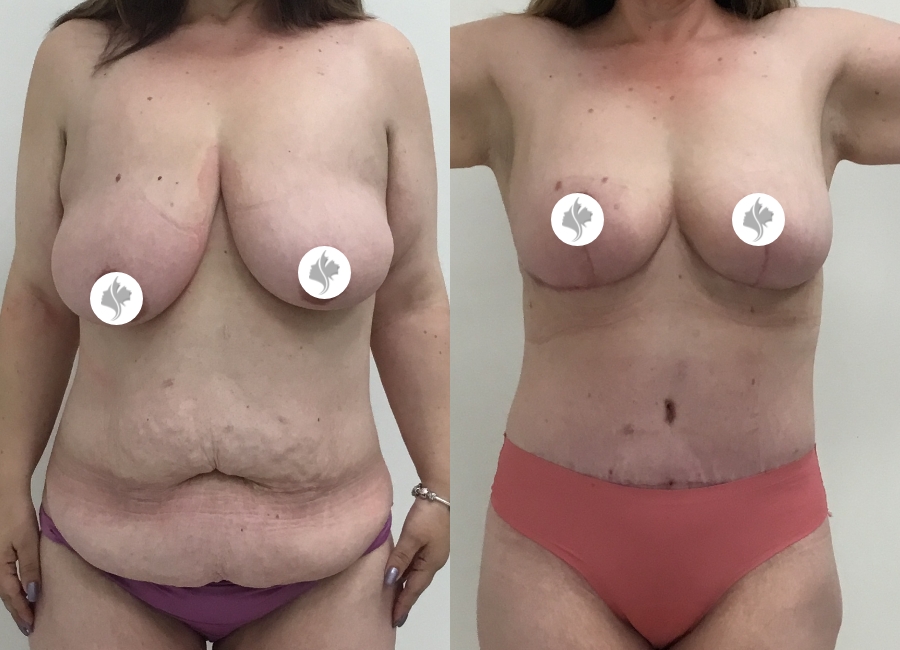 This is one of our beautiful tummy tuck patient 17