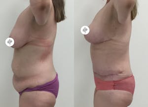 This is one of our beautiful tummy tuck patient 12