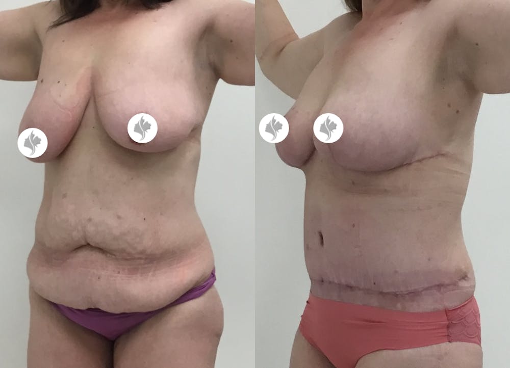 This is one of our beautiful tummy tuck patient #17