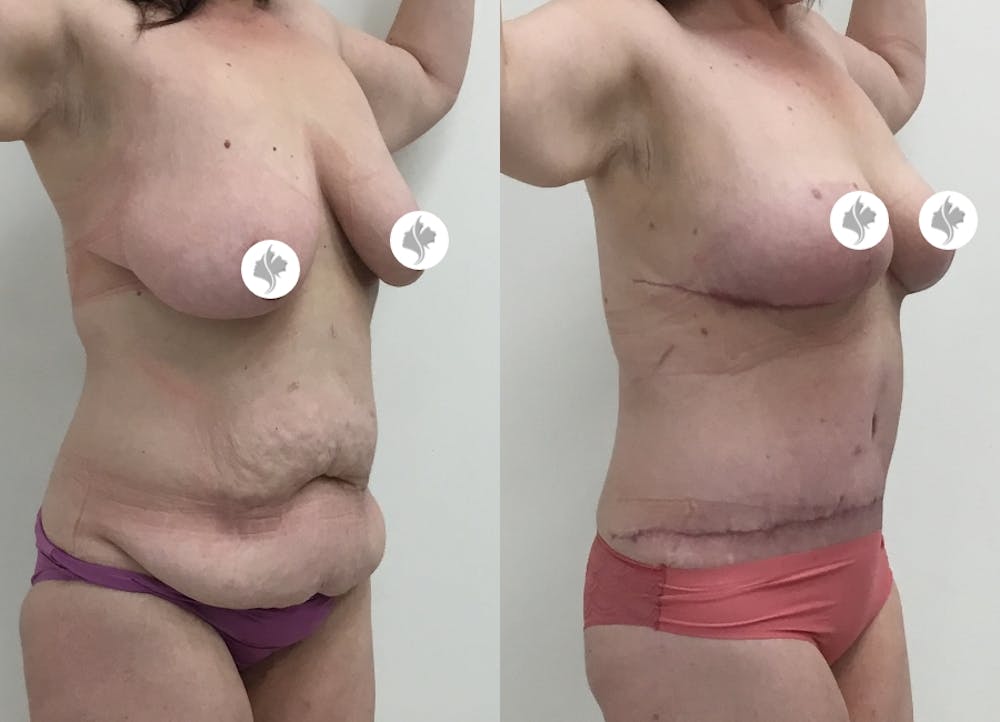 This is one of our beautiful tummy tuck patient #17
