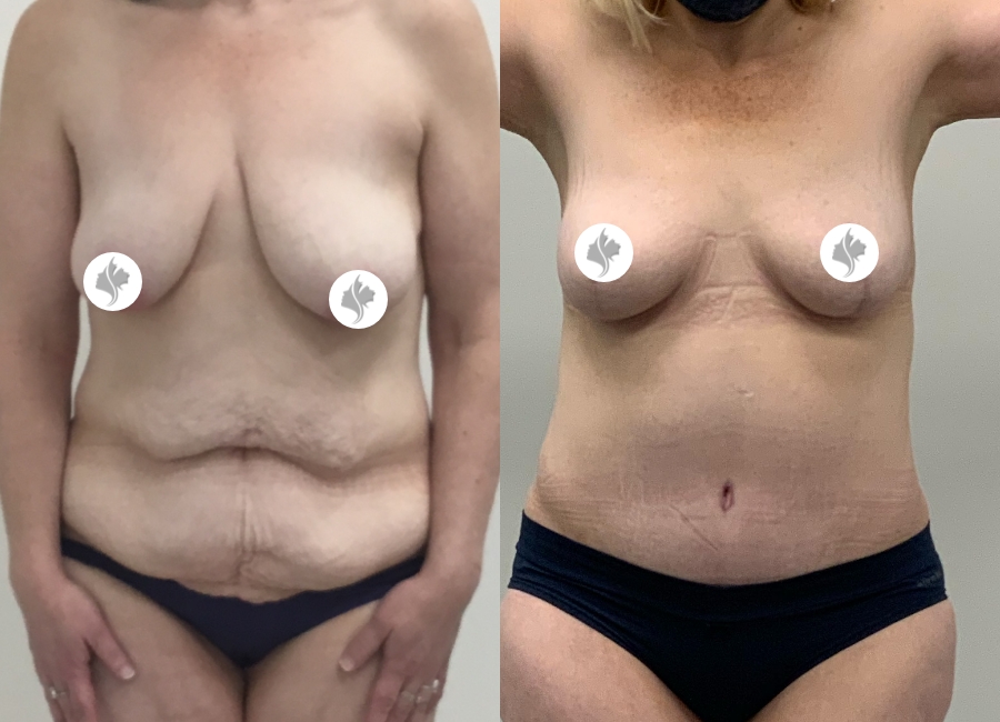 This is one of our beautiful tummy tuck patient 19