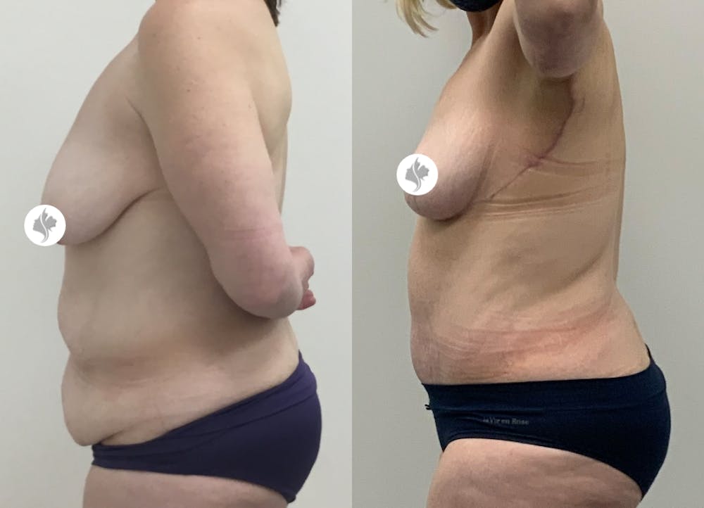 This is one of our beautiful tummy tuck patient #19