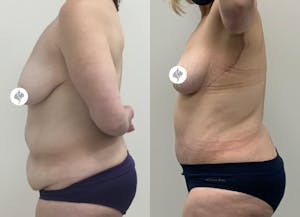 This is one of our beautiful post-bariatric body contouring patient 5
