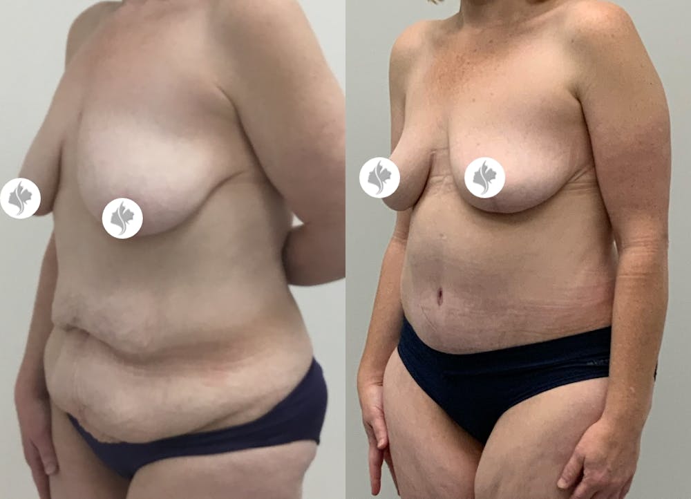 This is one of our beautiful tummy tuck patient #19