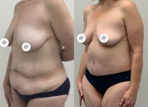 This is one of our beautiful post-bariatric body contouring patient 5
