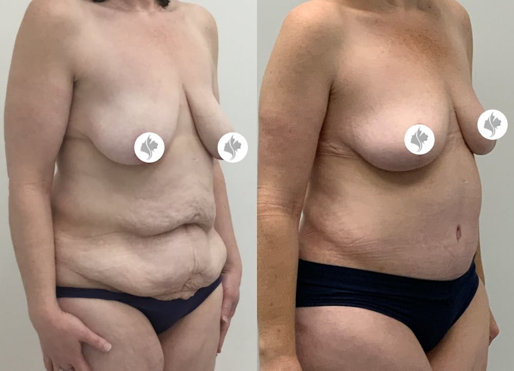 This is one of our beautiful post-bariatric body contouring patient #5