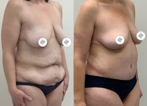 This is one of our beautiful tummy tuck patient 14