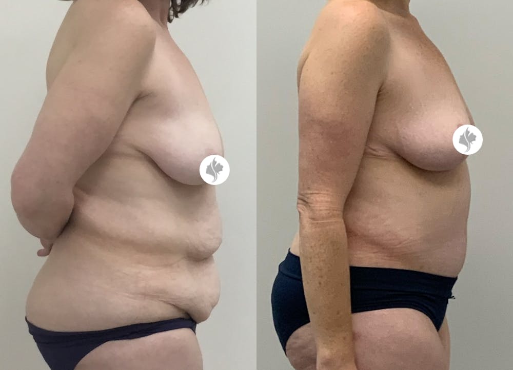 This is one of our beautiful post-bariatric body contouring patient #5