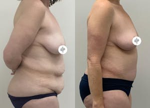This is one of our beautiful post-bariatric body contouring patient 5