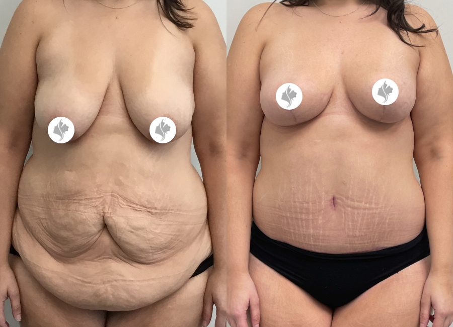 This is one of our beautiful post-bariatric body contouring patient 3