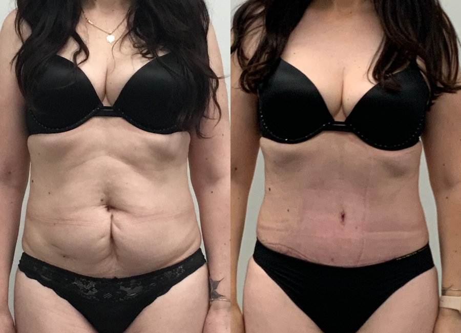 This is one of our beautiful tummy tuck patient 3
