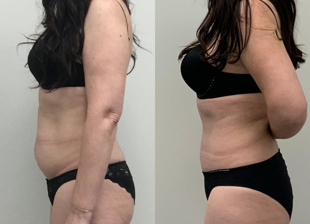 This is one of our beautiful tummy tuck patient #11