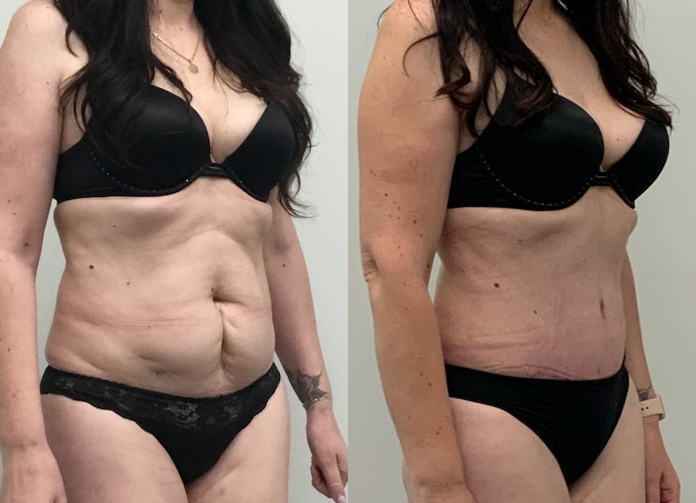 This is one of our beautiful tummy tuck patient #11