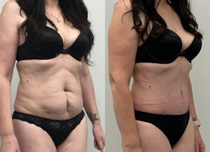 This is one of our beautiful tummy tuck patient 11