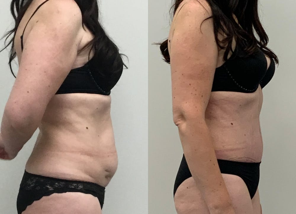 This is one of our beautiful tummy tuck patient #11