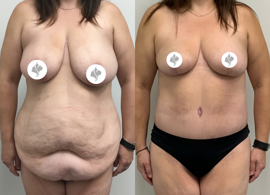 This is one of our beautiful post-bariatric body contouring patient 7