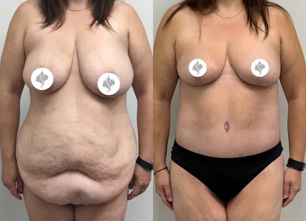 This is one of our beautiful post-bariatric body contouring patient #7