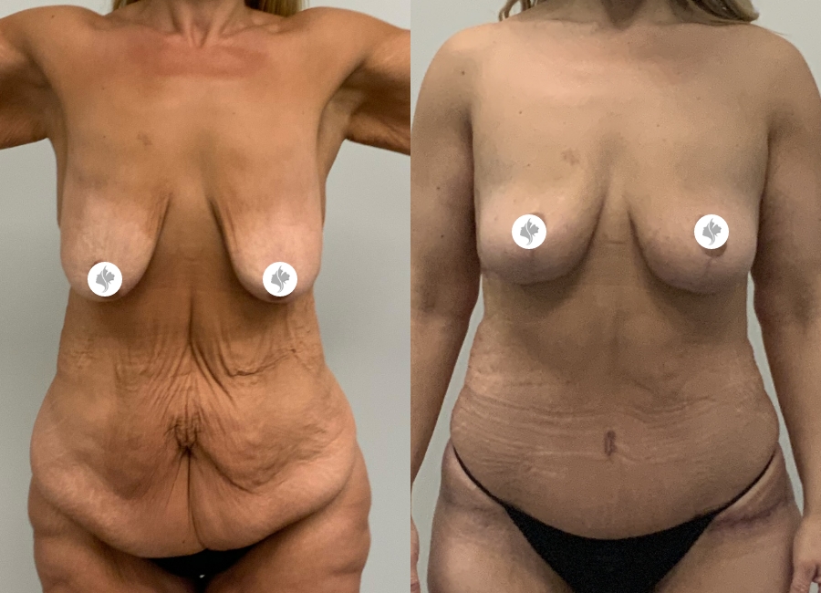 This is one of our beautiful post-bariatric body contouring patient 8