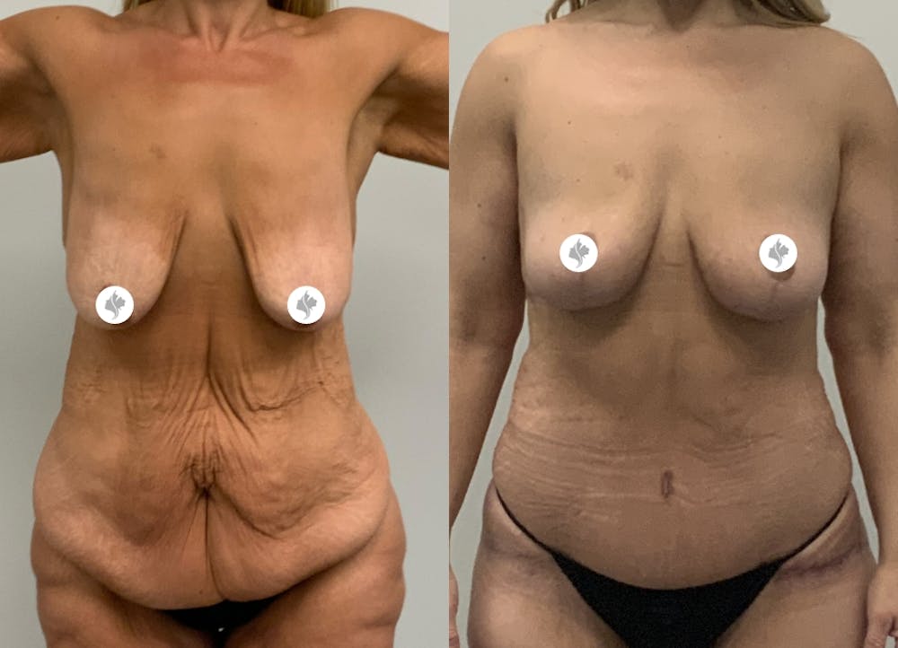 This is one of our beautiful post-bariatric body contouring patient #8