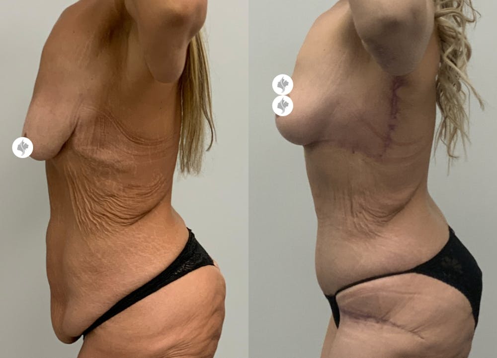 This is one of our beautiful post-bariatric body contouring patient #8