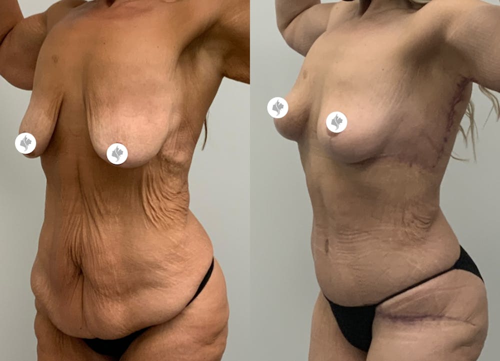 This is one of our beautiful tummy tuck patient #25